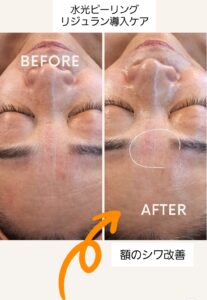 リジュラン導入before after_水光ピールスキン