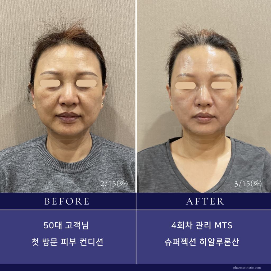 スーパージェクション_BeforeAfter_水光ピールスキン