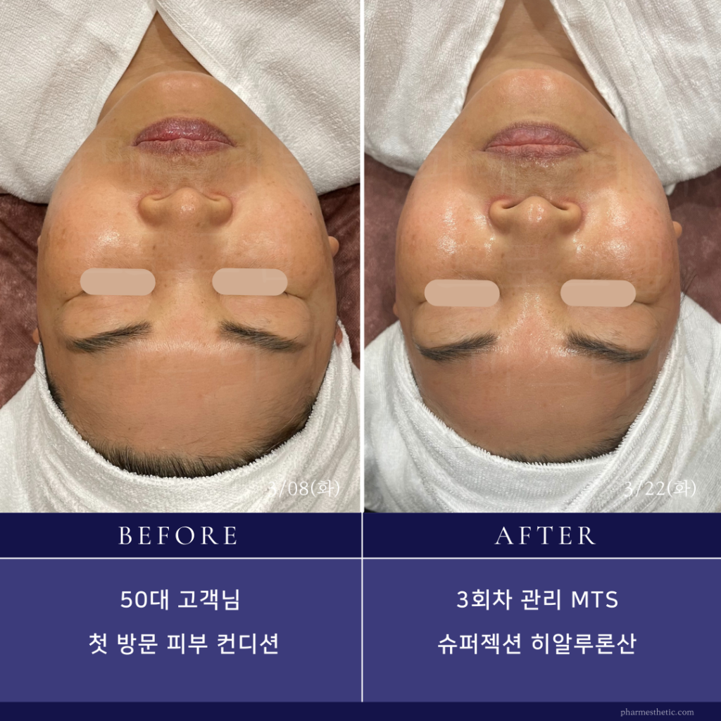 スーパージェクションコース_BeforeAfter_水光ピールスキン