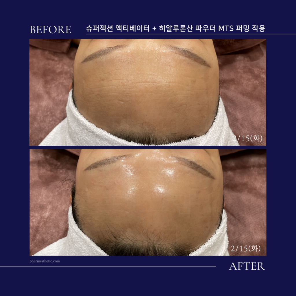 superjection_before_after_水光ピールスキン