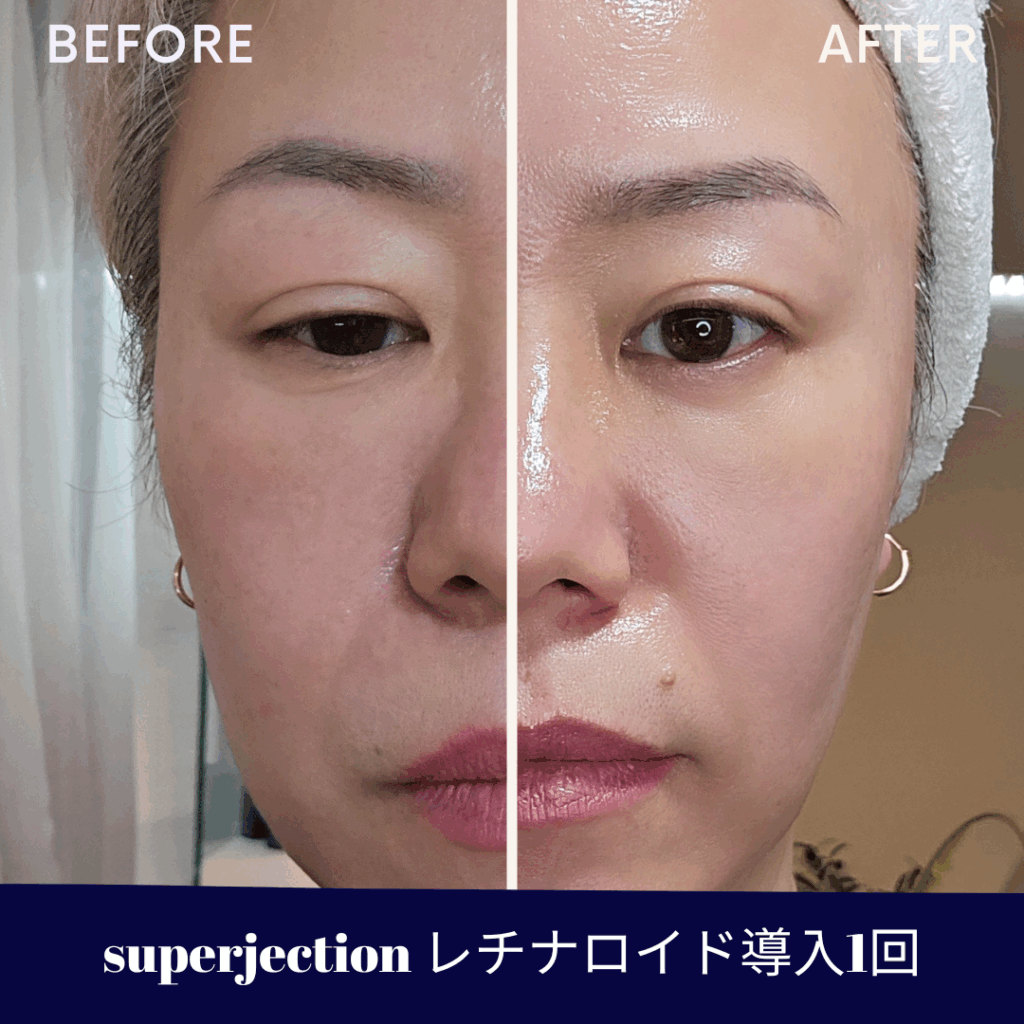 superjection_ビフォーアフター水光ピールスキン
