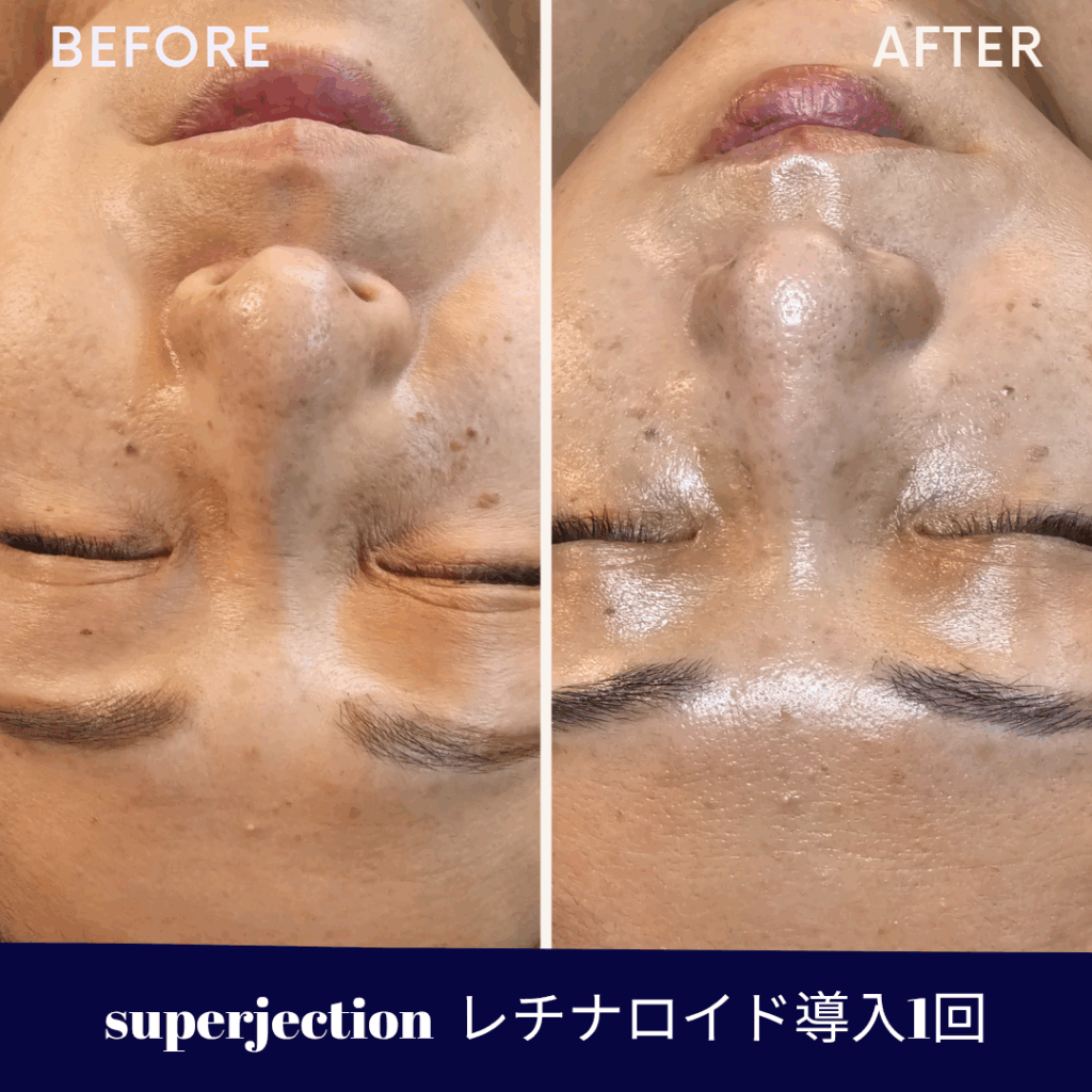 スーパージェクション_Before_After水光ピールスキン