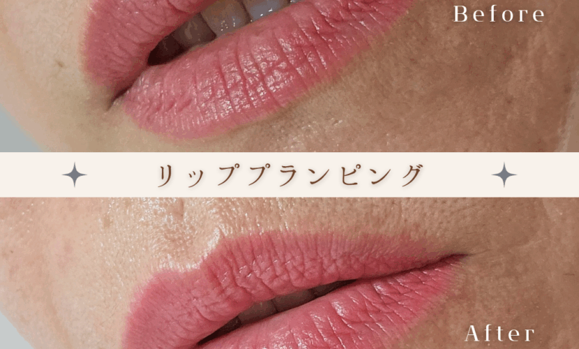 リッププランピングコース