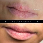 リッププランピング・フェイスプランピング解放間近