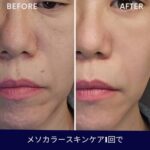 メソカラーってどんな施術？