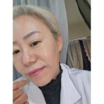 水光ピーリングって痛い？赤い？ダウンタイムは？