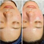 毛穴黒ずみなぜ取れない？